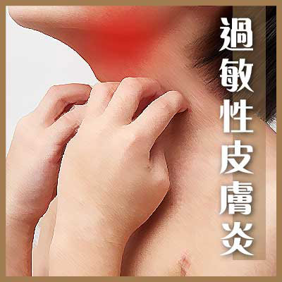 過敏性皮膚炎